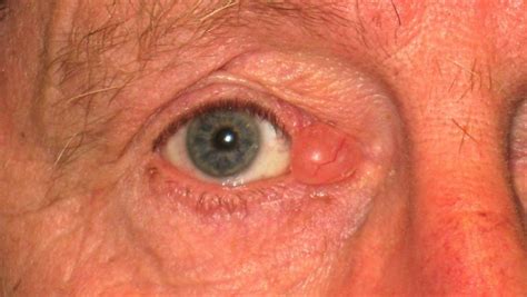 Treatment For Lump Inside Eyelid Chalazion Eyelid Cyst Mr David