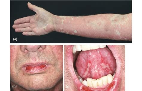 Cutaneous Graft Vs Host Disease A With Extensive Multiform Erythematous