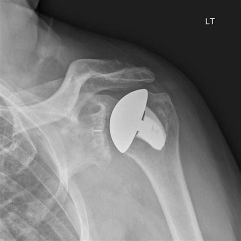 Dr Mcclintocks Shoulder X Ray Image Gallery Kyle Mcclintock Do Orthopedic Surgeon