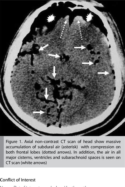 Figure From Mount Fuji Sign In Tension Pneumocephalus Semantic Scholar