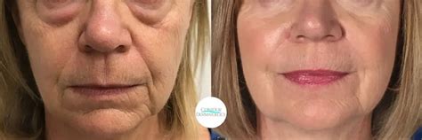 nasolabial fold excision contour dermatology