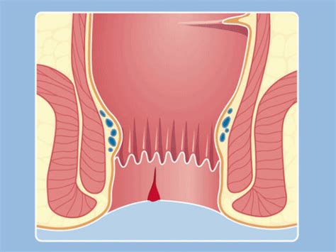 Anal fissure ZweiChirurgen Basel Zürich Liestal