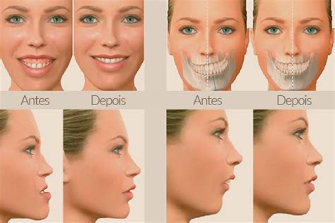 O Que É Bucomaxilo - Grupo SH Brasil :: O que é a cirurgia bucomaxilo facial?