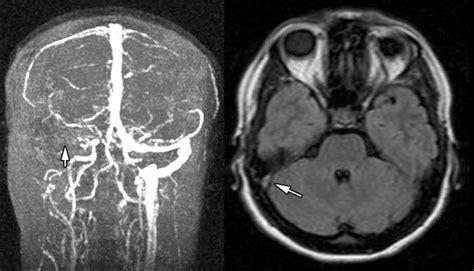 Mri And Mrv Showing Lateral Sinus Thrombosis In A 31 Year Old Female