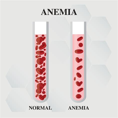 Anemia amount of red blood Iron deficiency anemia difference of Anemia