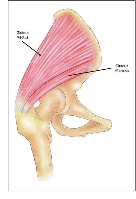 Hip Abductor Tendon Tears Where Are We Now Semantic Scholar