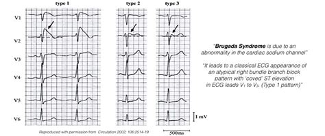 Common Conditions Melbourne Heart Rhythm