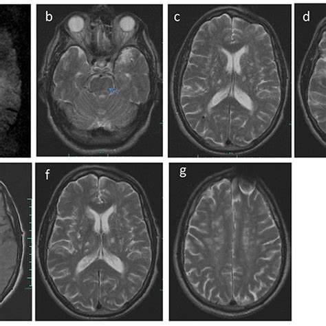 A Axial Diffusion Weighted Mr Image Showing A Right Paramedian High