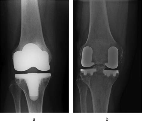 Early Outcomes After Robotic Arm Assisted Bi Unicompartmental Knee