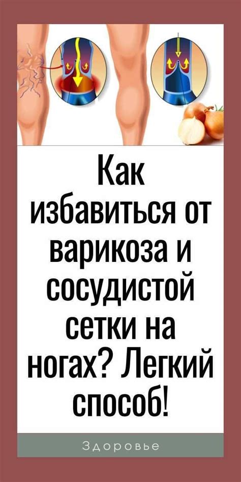 Как избавиться от варикоза и сосудистой сетки на ногах? Легкий способ ...
