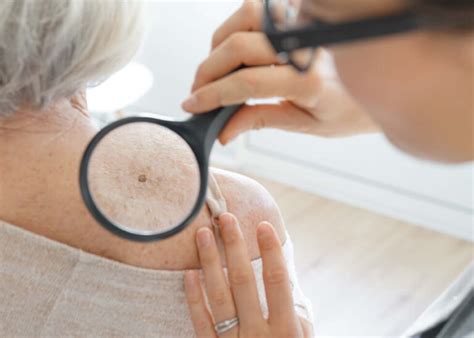 Squamous Cell Carcinoma Causes Treatment Dermatology Inc