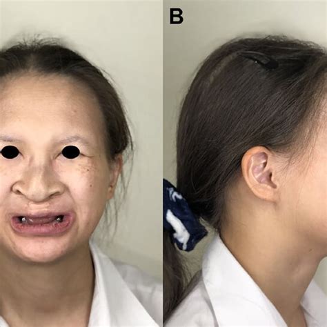 Photographs Of The Face Revealing Bilateral Cryptophthalmos Depressed