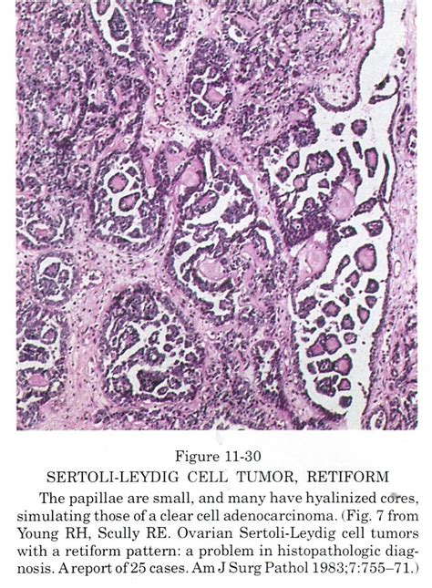 Pathology Outlines Sertoli Leydig Tumor