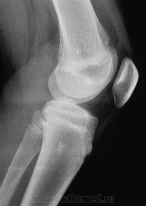 По поводу болей в коленном суставе направлен на рентгенографию | Портал ...