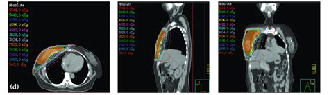 Dose Distribution Of A Imrt B Hybrid D Crt Imrt C