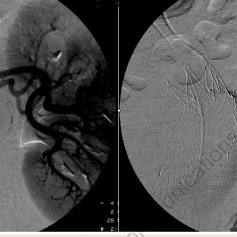 CT scan performed 2 days after endovascular aneurysm repair revealing a ...