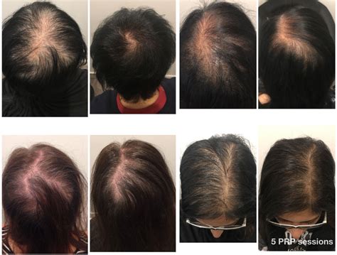 Prp Hair Loss Treatment Sydney Melbourne And Brisbane