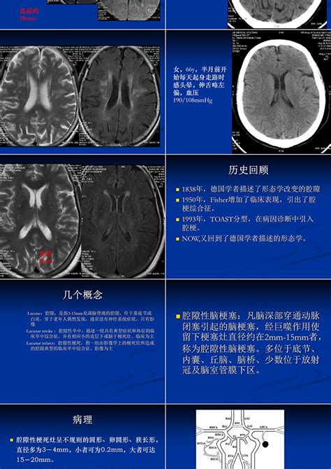 腔隙性脑梗死ppt卡卡办公