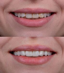 How Do Veneers Work? Process, Benefits, and What to Expect