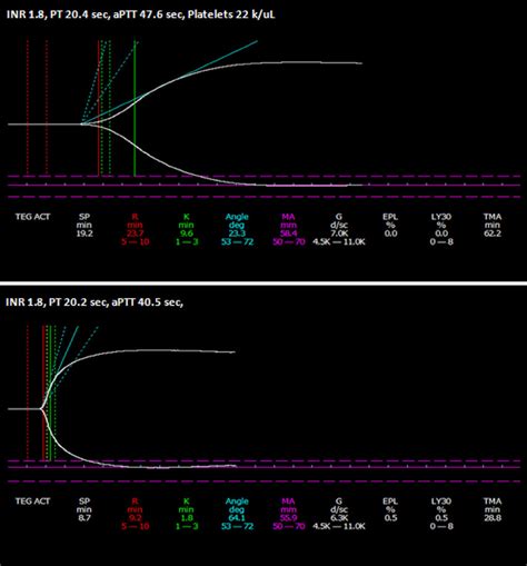 Teg During Defibrotide Therapy With Corresponding Abnormal Rct Top