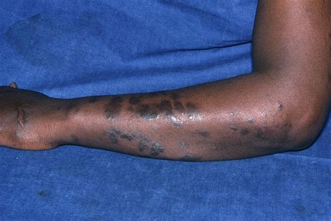 Kaposis Sarcoma Skin Plaques Photograph By Dr Ma Ansaryscience