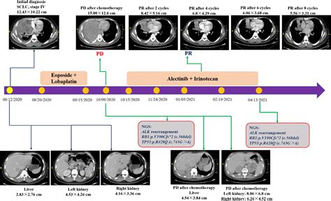 Figure 1 from ALK Rearrangement in Small-Cell Lung Cancer and Durable ...