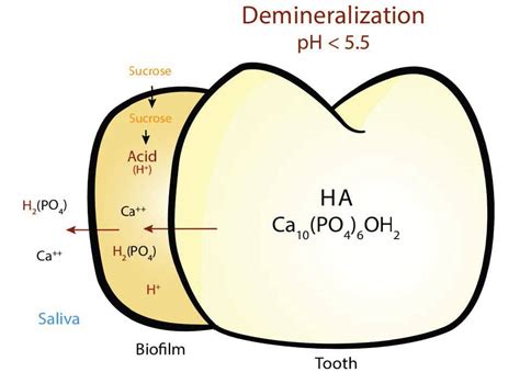 Remineralization 1 Decisions In Dentistry
