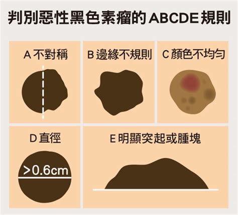 痣長成一排、會痛會癢會是黑色素癌嗎？ 康健雜誌