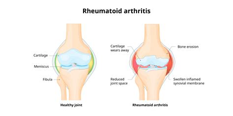 Rheumatoid Arthritis : Disease Background | MIMS Philippines