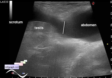 Scrotum Sonography Scrotum Cyst Like Hydrocele Clinical Report