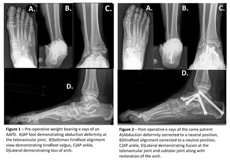 Posterior Tibial Tendon Insufficiency Campbelltown Private Hospital