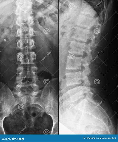 Radiograf A De La Espina Dorsal Lumbar Con Skoliosis S Shaped Leve