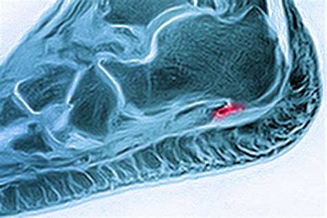 Enthesitis and Enthesopathy Explained