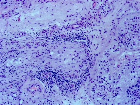 Life Free Full Text Leydig Cells In Patients With Non Obstructive