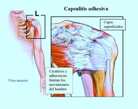 Dolor Externo De Hombro Y De Brazo Al Levantar Tendinitis Tratamiento