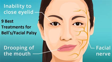 9 Best Treatments For Bellsfacial Palsy