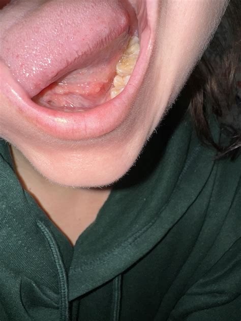pale white/ yellow bump under tongue : r/askadentist
