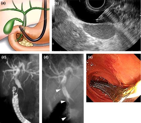 Biliary Endoscopy Guidelines At Lisa Bazan Blog