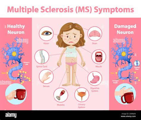 Multiple sclerosis (MS) symptoms information infographic Stock Vector ...