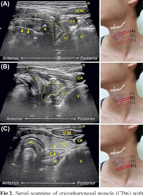 Figure 2 From Ultrasonography Guided Botulinum Toxin Injection To The