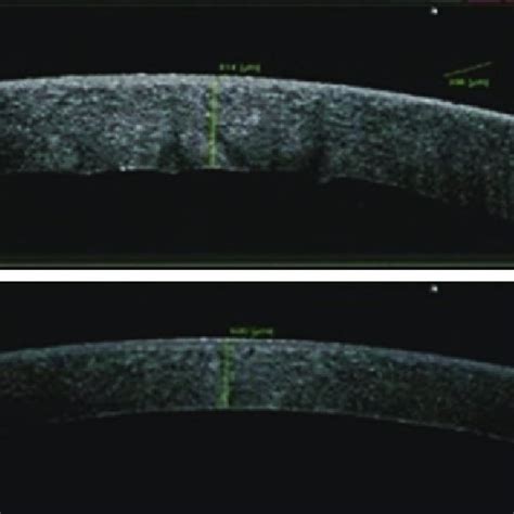 patients demographics angle closure glaucoma patients  table