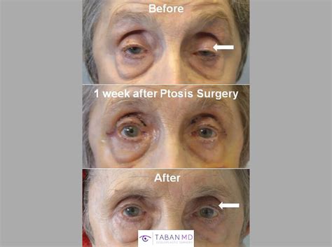 Eyelid Ptosis Before and After Gallery | Taban MD