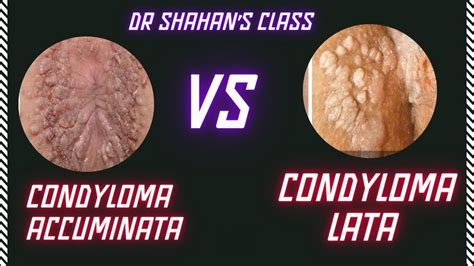 Condyloma Accuminata Vs Condyloma Lata Dermatology Fmge Neetpg Inicet Youtube