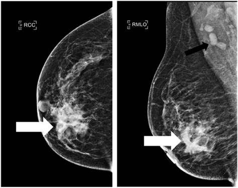 Granulomatous Mastitis Of The Breast A Malicious Mimic Frederick J