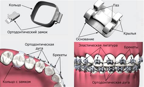 Кольцо ортодонтическое