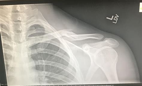 My clavicle fractures before and after. (Snow boarding accident) : r