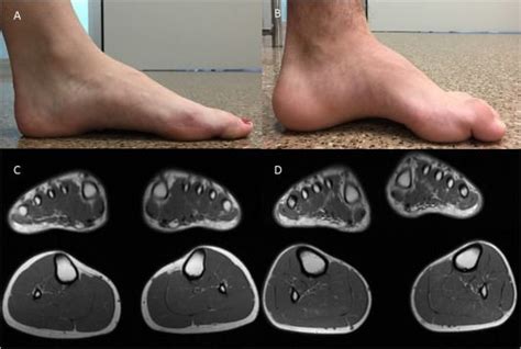 Penyakit Charcot Marie Tooth Penyebab Gejala Pengobatan