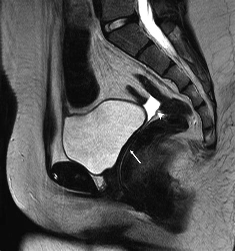 Sagittal T Tse Shows A Blind Ended Vagina White Arrow Between The