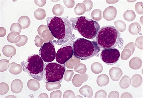 Leukemia Acute Acute Monoblastic And Acute Monocytic Leukemia Aml M5