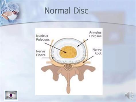 Normal Spine/Normal Disc/Painful Disc/Herniated disc | PPTX | Death